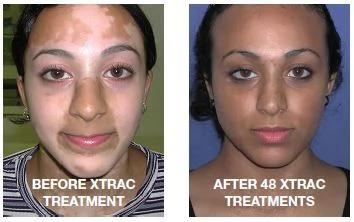 Get Rid Of Vitiligo In Somerville City in Massachusetts, Tattoo Removal Oil In USA Call +27710732372 | Foto 3