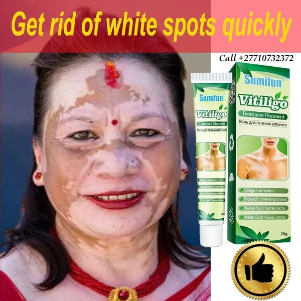 Get Rid Of Vitiligo In Somerville City in Massachusetts, Tattoo Removal Oil In USA Call +27710732372